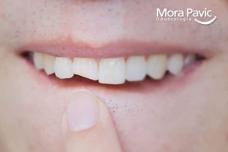 Rehabilitacion Oral