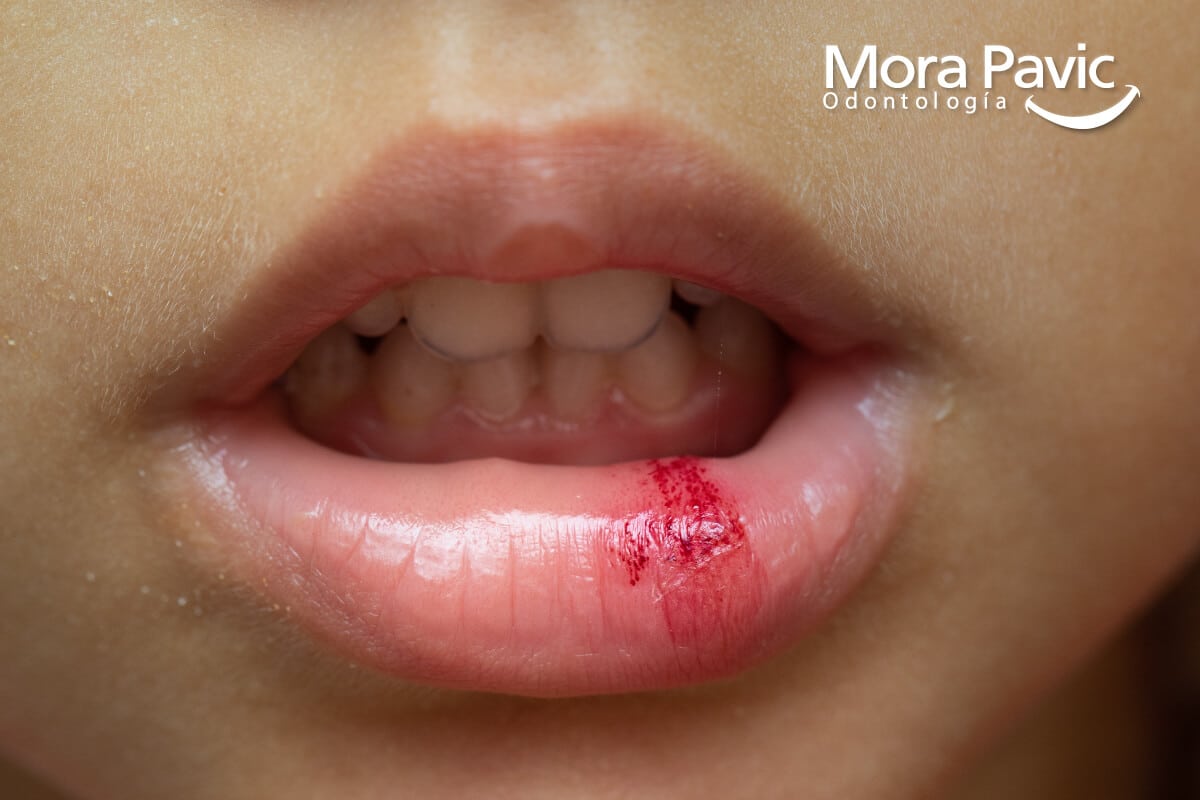 accidente dental