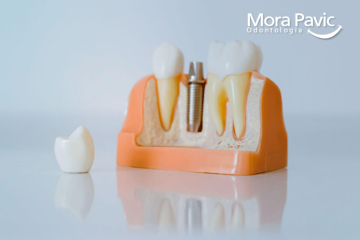implantes dentales