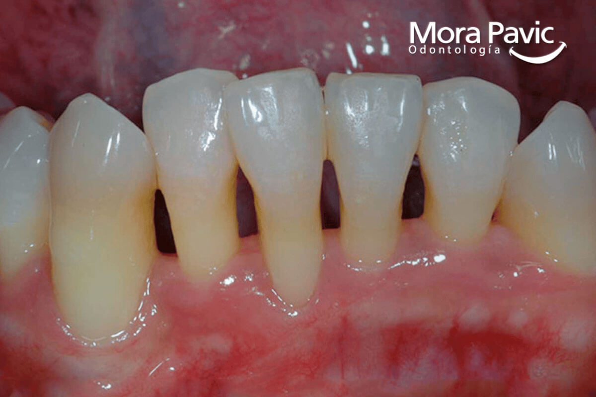 periodontitis