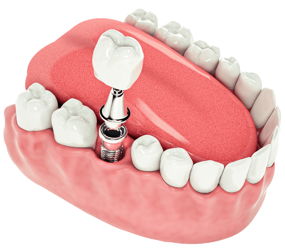 implante dental unitario