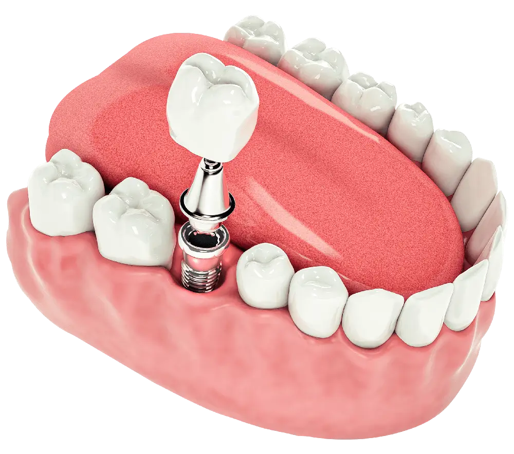 implante dental unitario