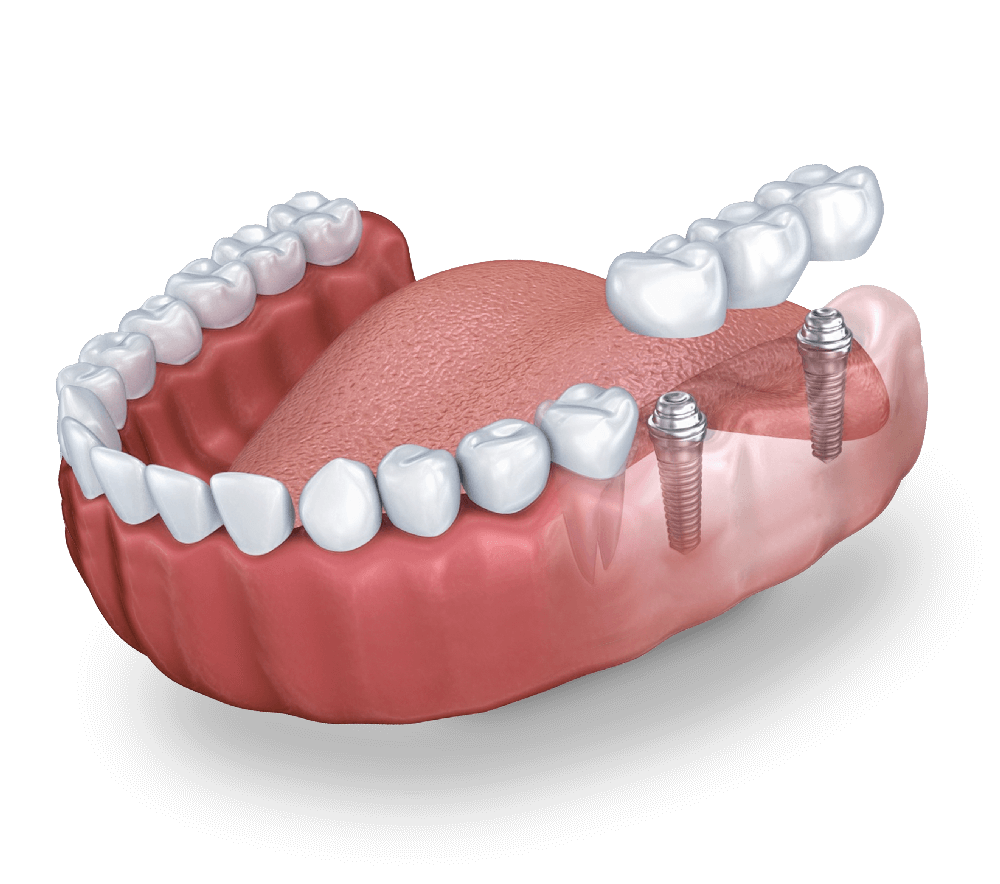 implantes dentales con puente