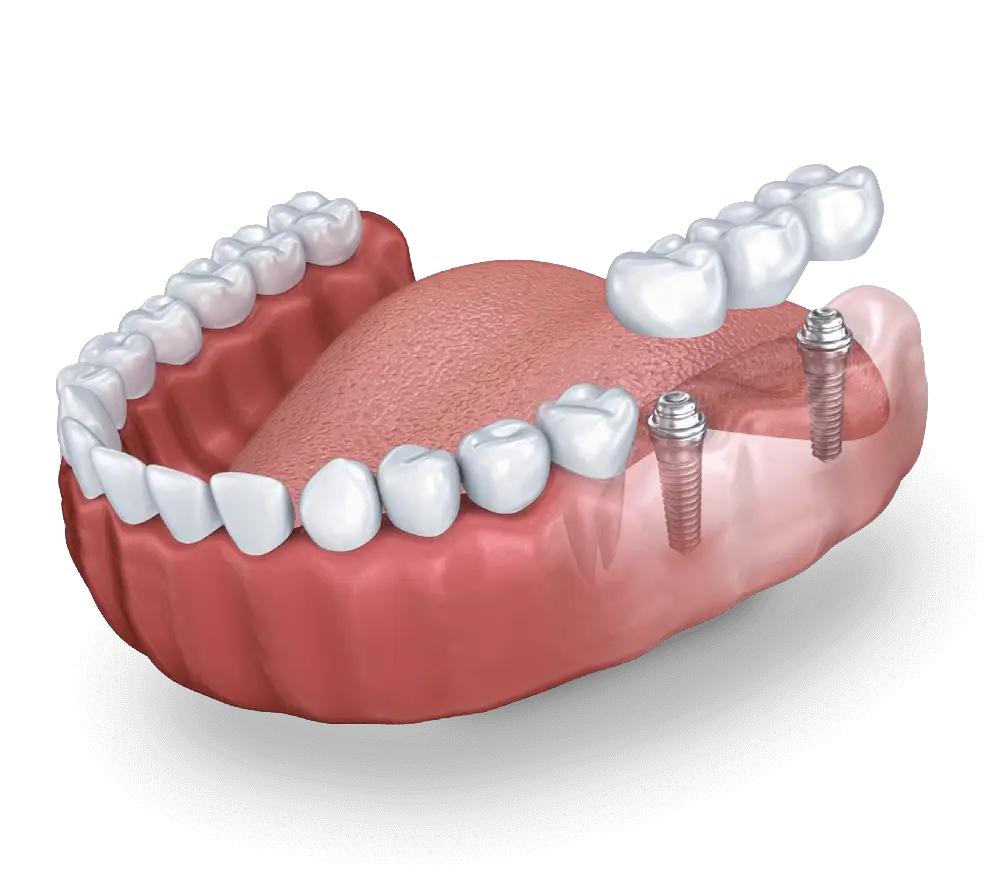 implantes dentales con puente