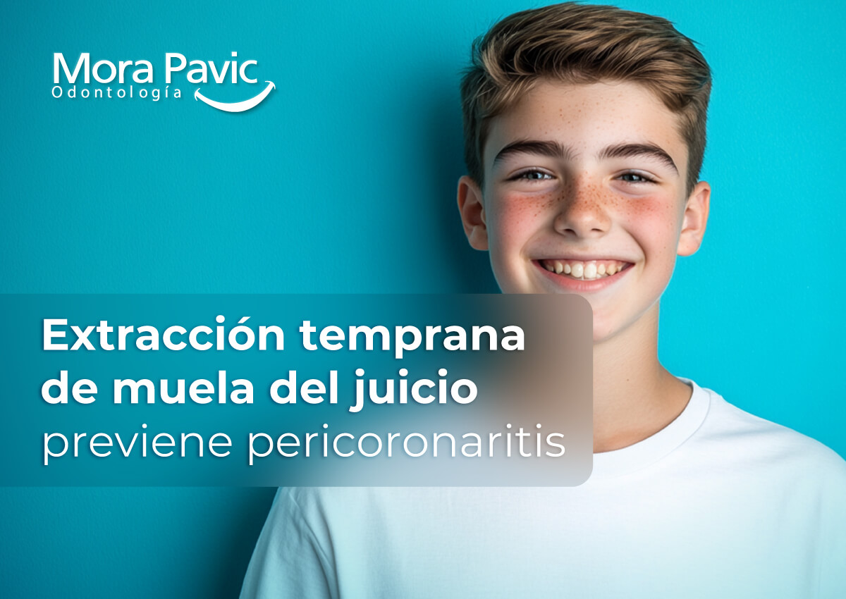 Extracción-temprana-de-muela-del-juicio-previene-pericoronaritis