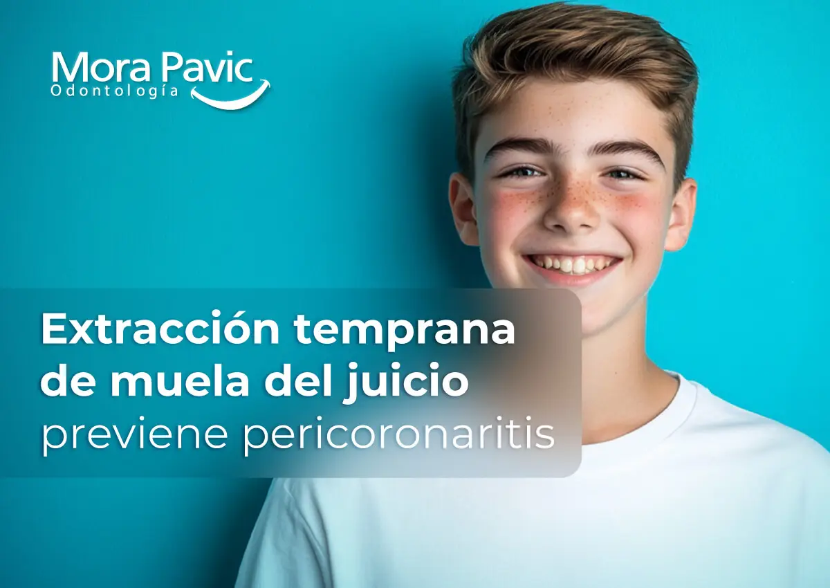 Extracción-temprana-de-muela-del-juicio-previene-pericoronaritis