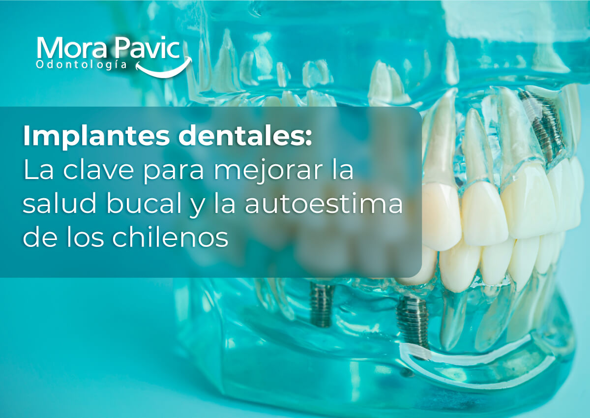 Implantes-dentales--la-clave-para-mejorar-la-salud-bucal-y-la-autoestima-de-los-chilenos