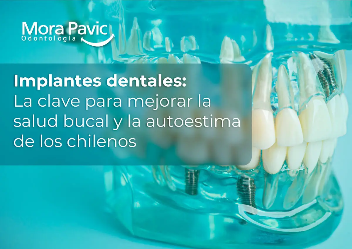 Implantes-dentales--la-clave-para-mejorar-la-salud-bucal-y-la-autoestima-de-los-chilenos