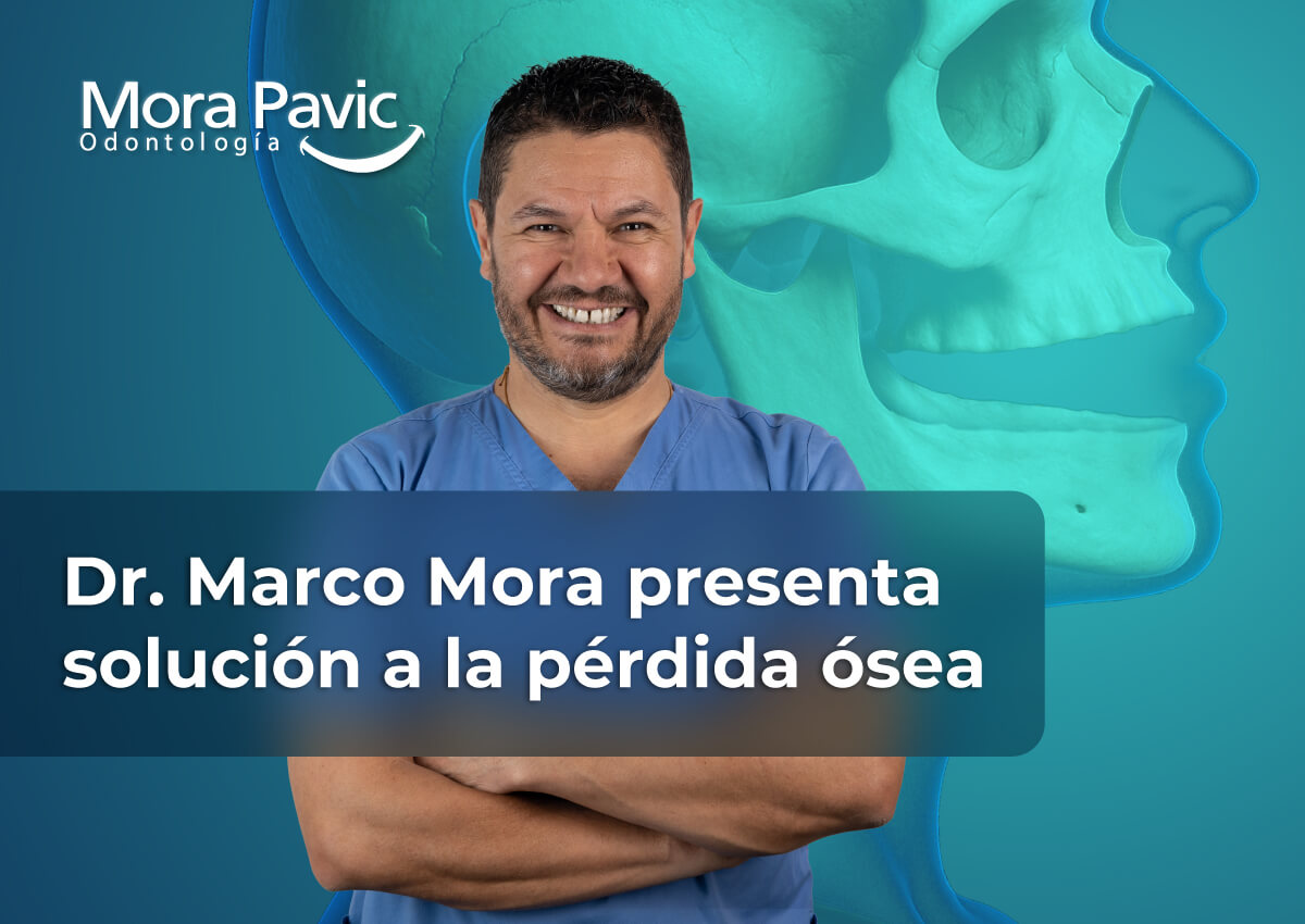 Implantes-cigomaticos