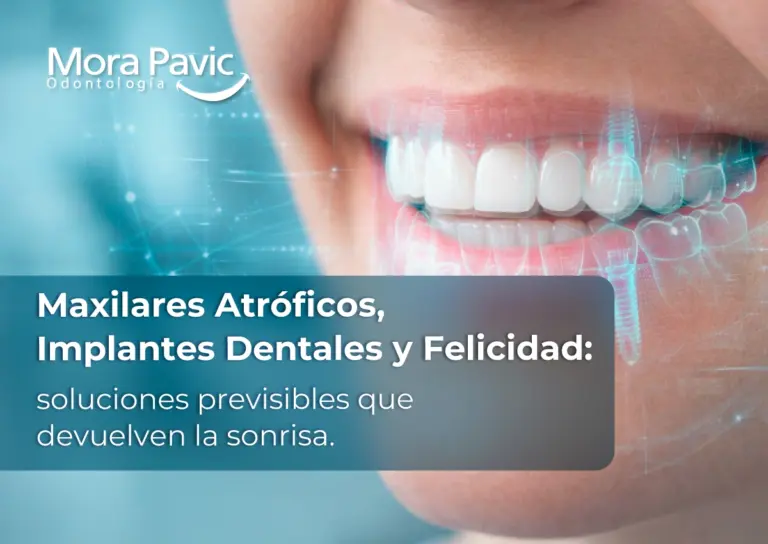 Maxilares-Atróficos,-Implantes-Dentales-